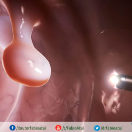 Colonoscopia-Por-Dr-Fabio-Atui