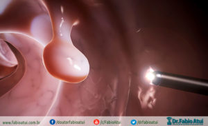 Colonoscopia-Por-Dr-Fabio-Atui