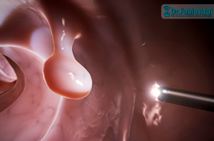 Colonoscopia - Por Dr. Fabio Atui - Cirurgia do Aparelho Digestivo e Coloproctologista