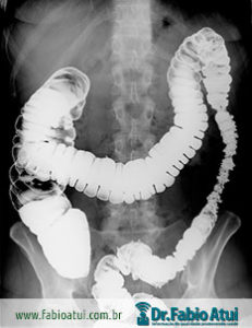 Enema Opaco - Exames - Por Dr Fabio Atui - - Cirurgia do Aparelho Digestivo e Coloproctologista