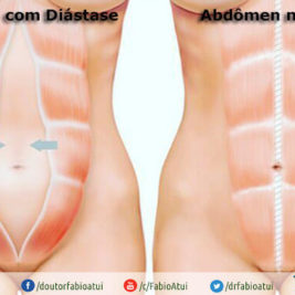 Diástase reto abdominal - Por Dr Fabio Atui - Cirurgia do Aparelho Digestivo e Coloproctologista
