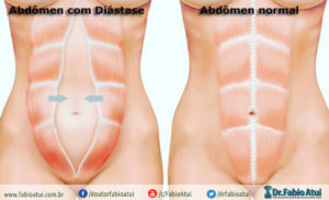 Diástase reto abdominal - Por Dr Fabio Atui - Cirurgia do Aparelho Digestivo e Coloproctologista