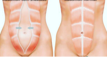 Diástase reto abdominal - Por Dr Fabio Atui - Cirurgia do Aparelho Digestivo e Coloproctologista