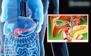 Retirada da vesícula biliar - Por Dr Fabio Atui - Cirurgia do Aparelho Digestivo e Coloproctologista
