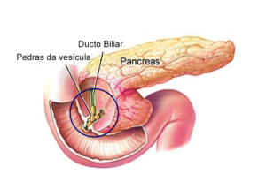Retirada da vesícula biliar - Por Dr Fabio Atui - Cirurgia do Aparelho Digestivo e Coloproctologista